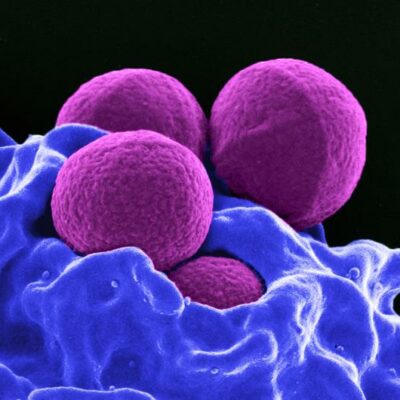 Electron microscope image of Staphylococcus aureus (MRSA) bacteria, depicted as four magenta-colored spheres being phagocytized by a blue-colored human white blood cell.