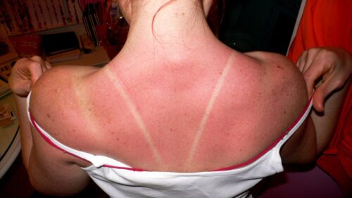 Photo of a women's sunburnt back, white lines evident where her shirt straps were. 