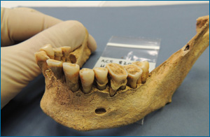 Late Iron Age/Roman woman showing large dental calculus deposit, from Cambridge area, UK.