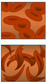 top, red blood cells; bottom, sickle cells.